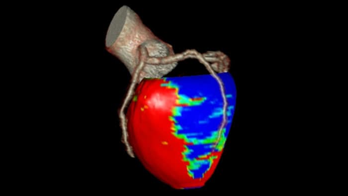 myocardial defect assessment