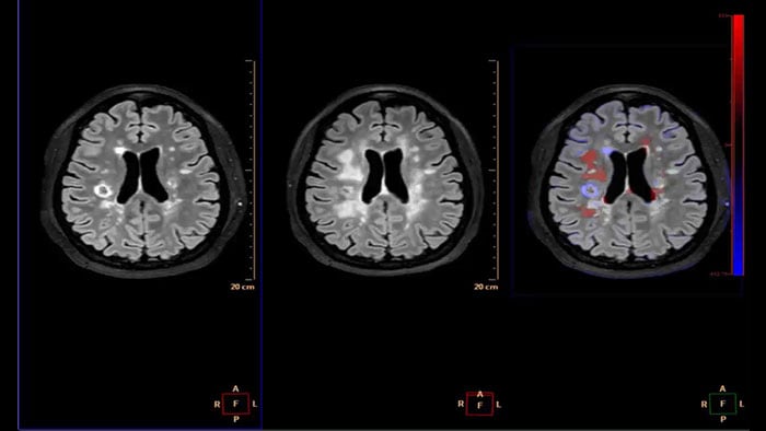 longitudinal brain imaging thumbnail