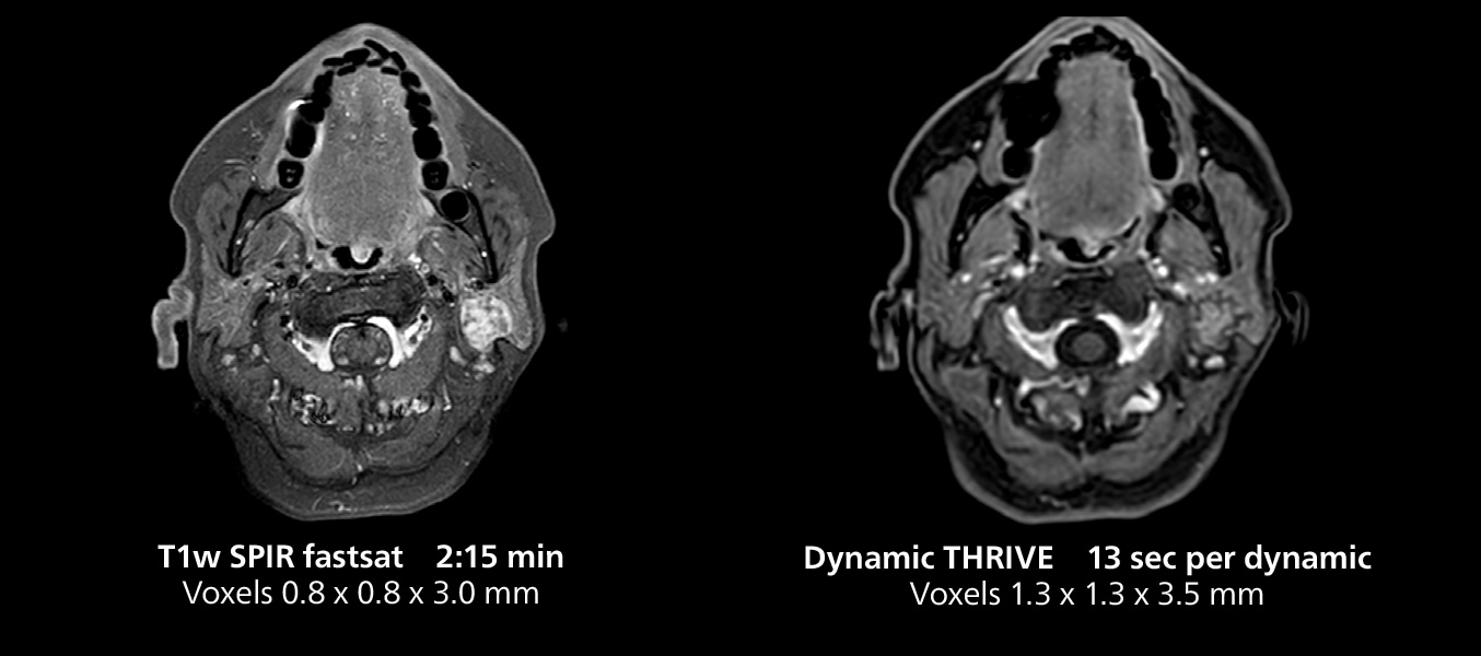 Salivary gland mri three