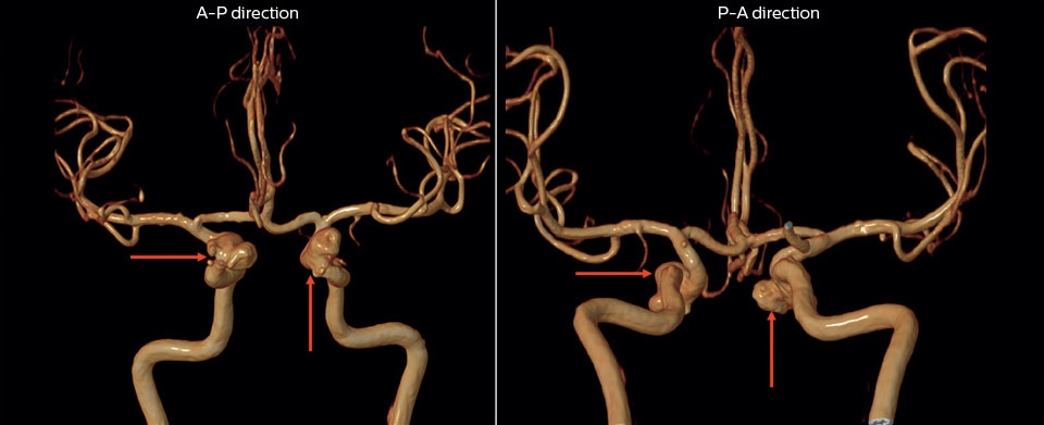 magnetic resonance angiography of multiple cerebral aneurysms