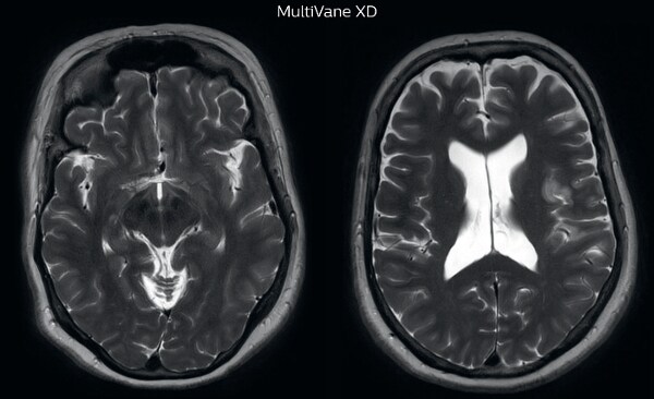 UVM case 2 motion artifact MultivaneXD 