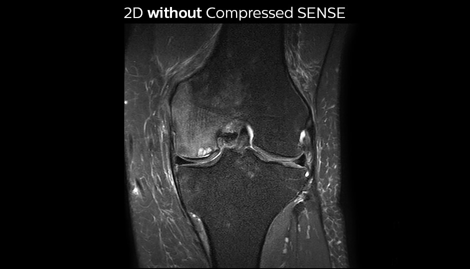 PD-FS-SPAIR-knee-without-Compressed-SENSE-cor