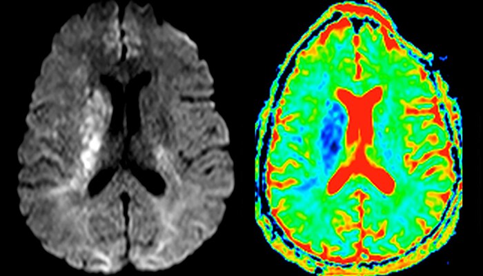 Acute ischemic stroke with ica