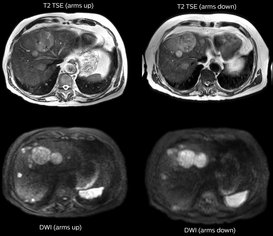 fieldstrength liver mr clinical case 1