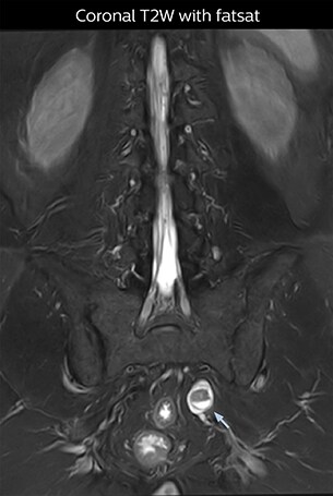 Coronal T2W with fatsat