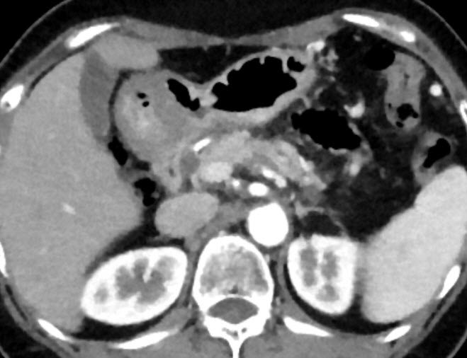 Pancreatic cancer