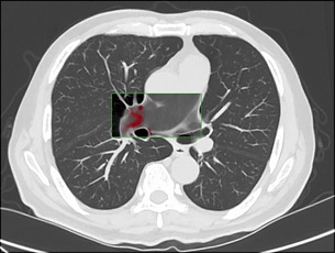 pe chest axial download image