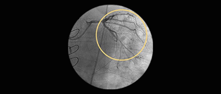 Left main disease masthead