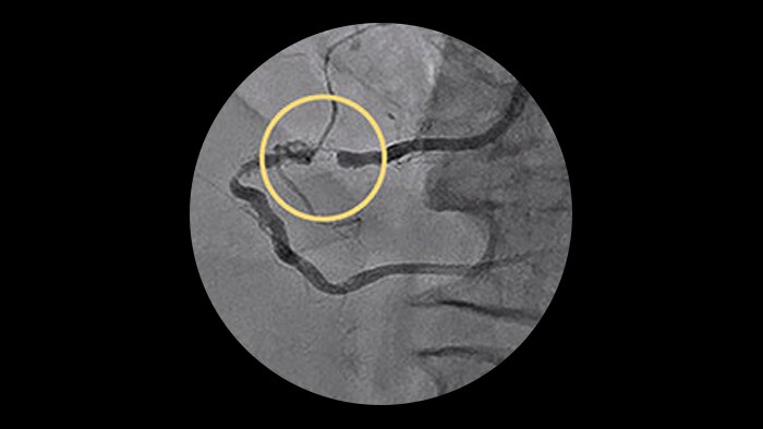 In-stent restenosis