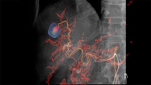 Guidance EmboGuide 1 LM