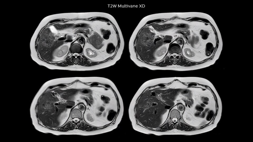 Bremen Clinical case liver MRI