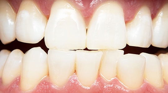In Office Professional Teeth Whitening Philips Zoom